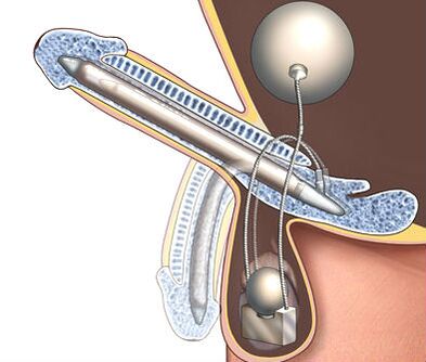 penile prosthesis to enlarge it
